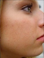 Acne Facial After