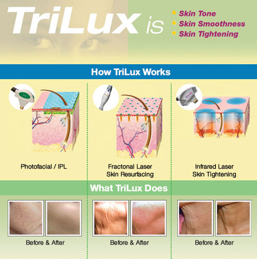 ing-trilux