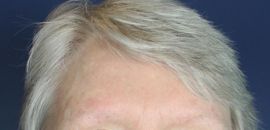After Image: Botox - front