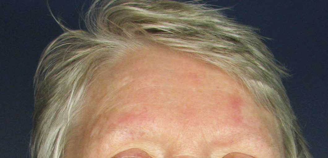 Before Image: Botox - front