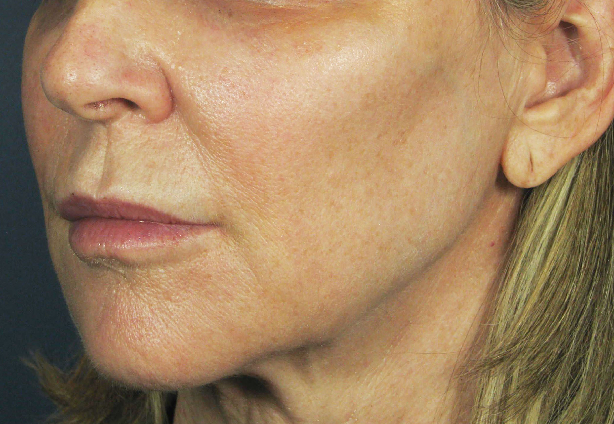 After Image: Botox - left-front-oblique