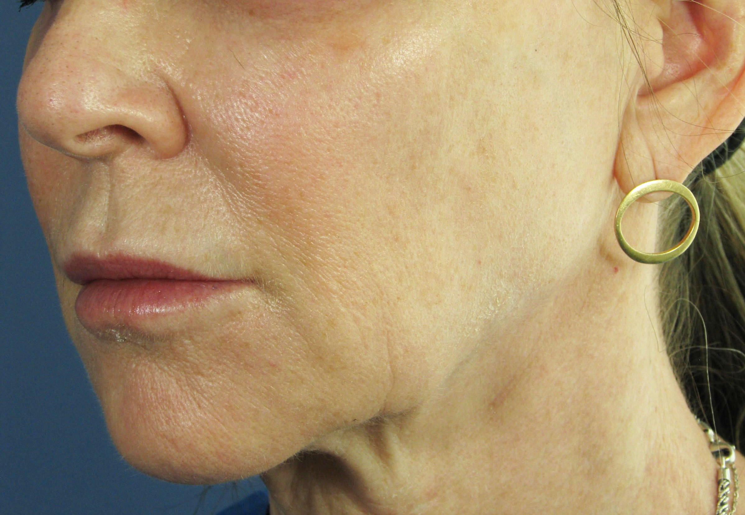Before Image: Botox - left-front-oblique