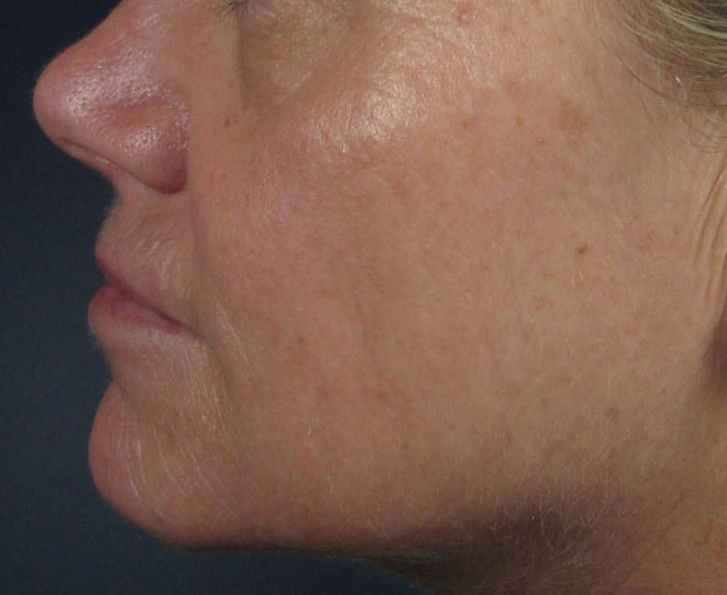 After Image: CO2 Fractional Laser Resurfacing - left-side