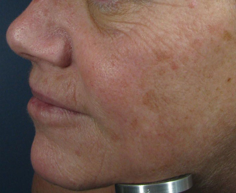 Before Image: CO2 Fractional Laser Resurfacing - left-side