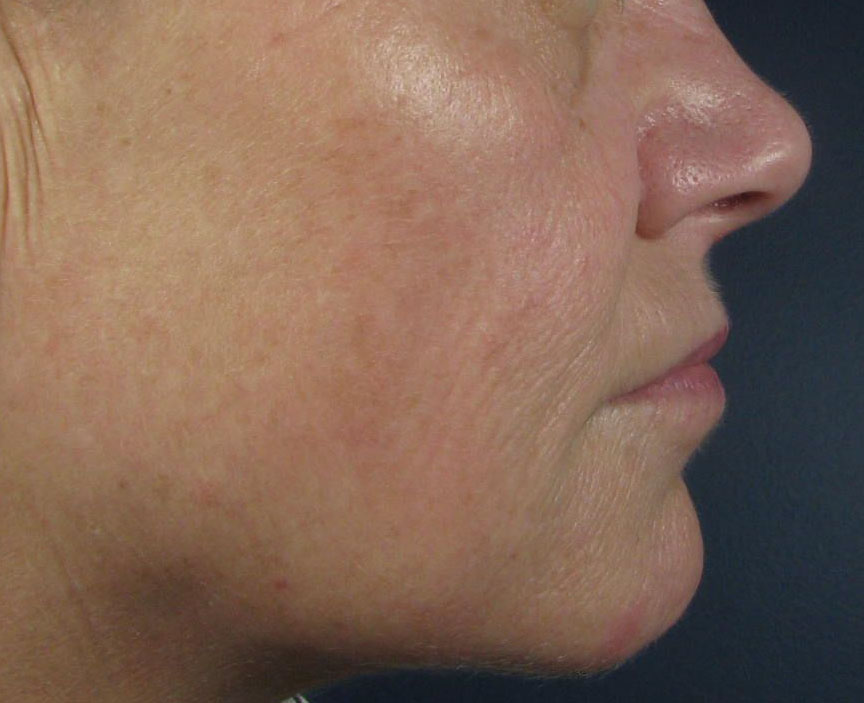 After Image: CO2 Fractional Laser Resurfacing - right-side
