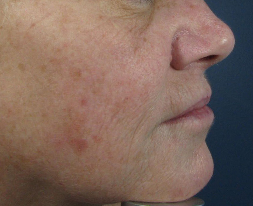 Before Image: CO2 Fractional Laser Resurfacing - right-side
