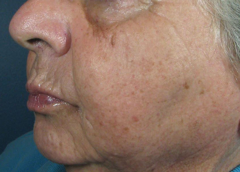 After Image: CO2 Fractional Laser Resurfacing - left-front-oblique