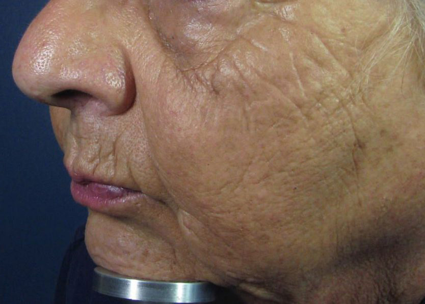 Before Image: CO2 Fractional Laser Resurfacing - left-front-oblique
