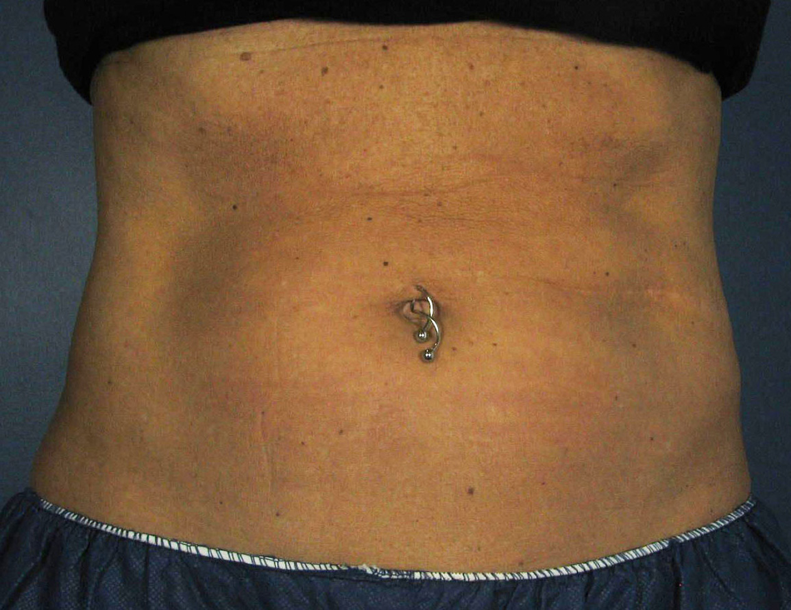 After Image: CoolSculpting - front