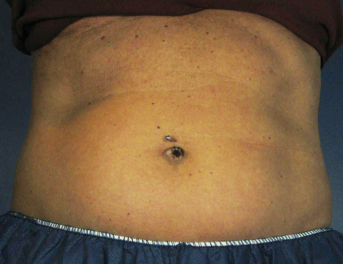 Before Image: CoolSculpting - front