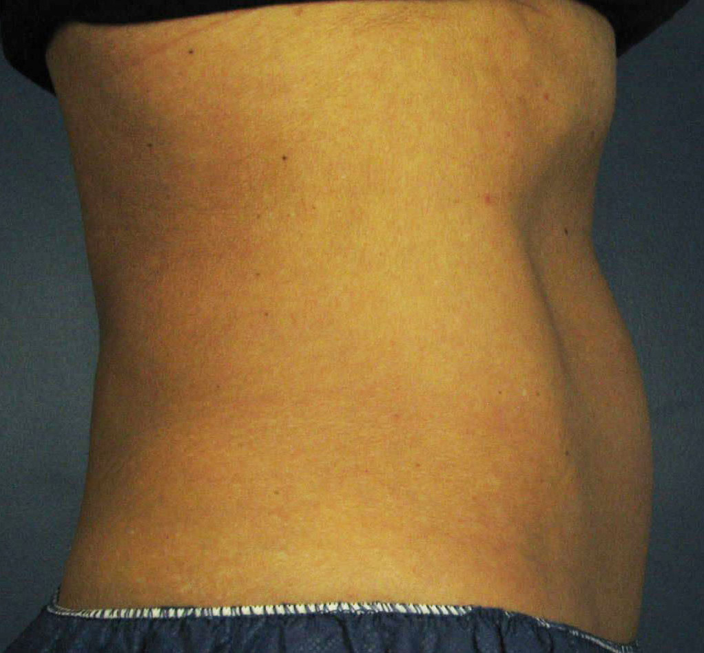 After Image: CoolSculpting - front