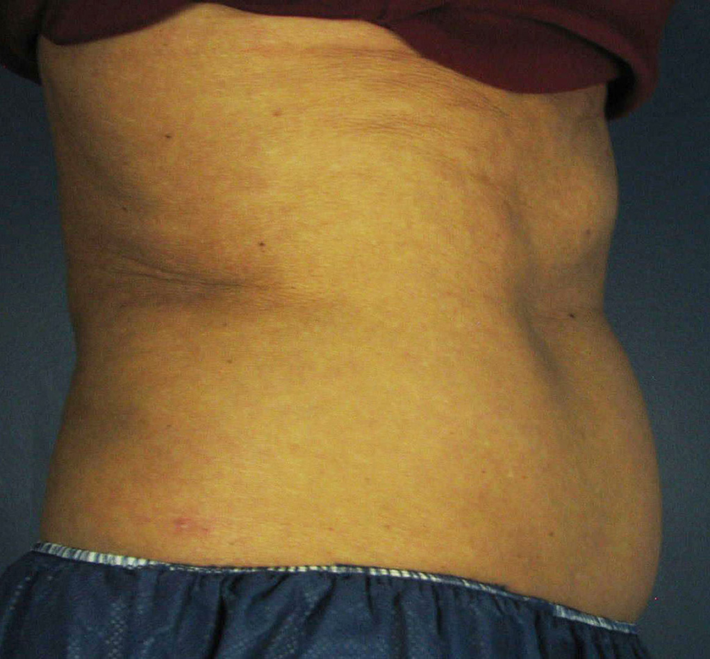 Before Image: CoolSculpting - front