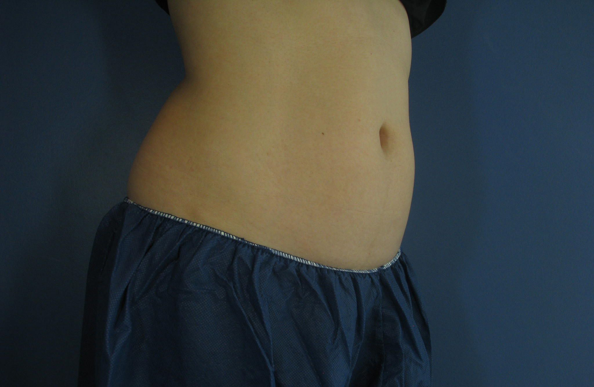 After Image: CoolSculpting - right-side