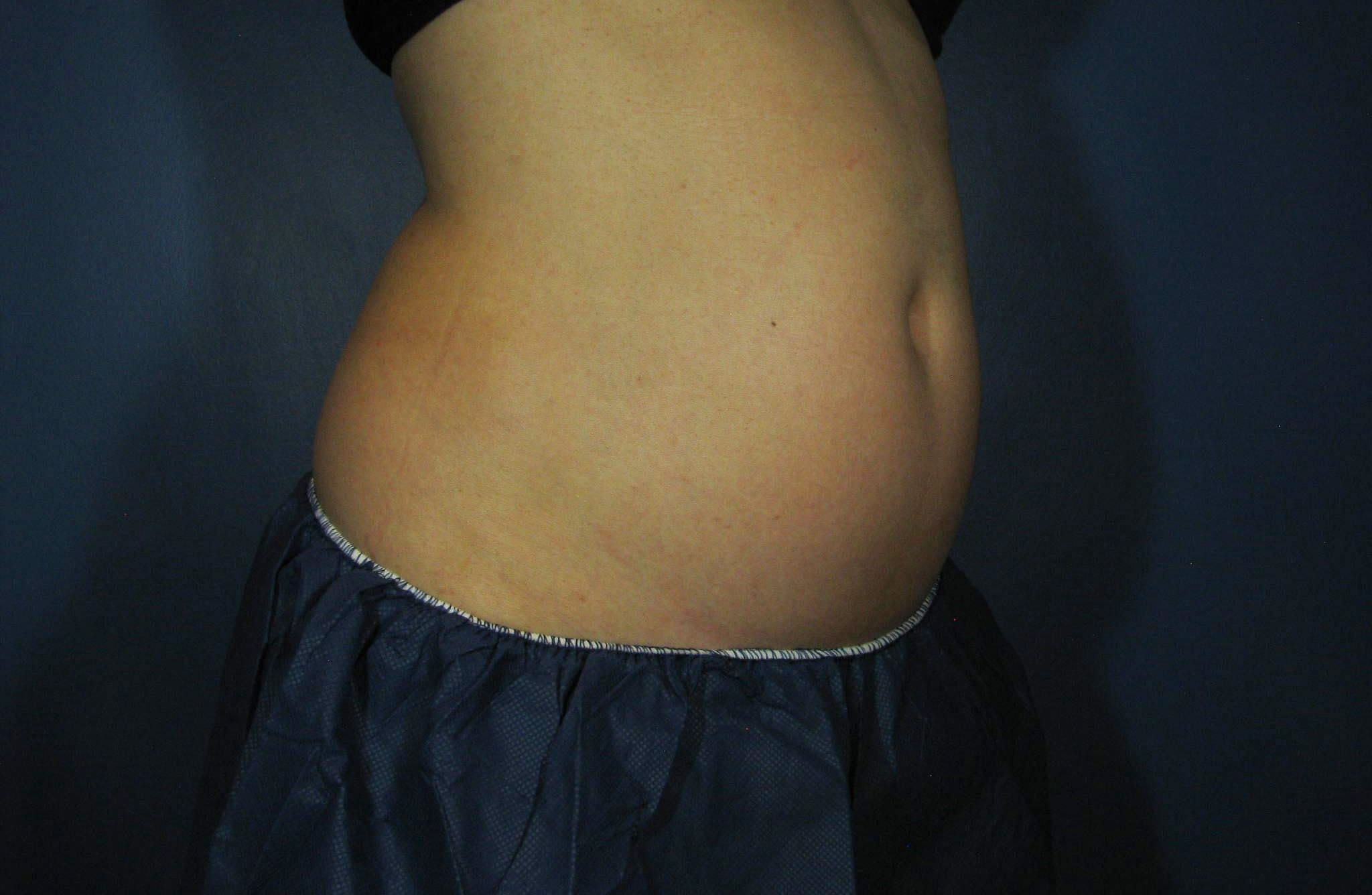 Before Image: CoolSculpting - right-side