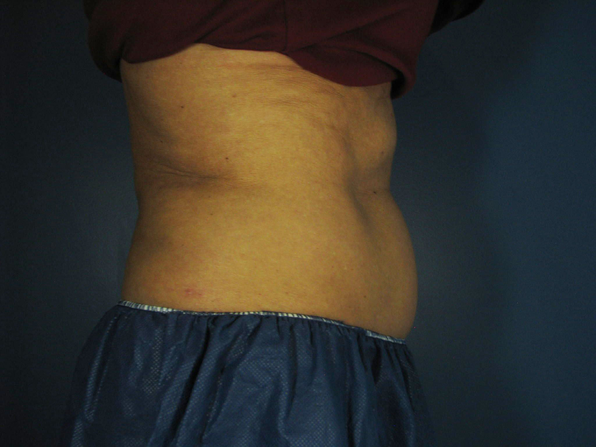 Before Image: CoolSculpting - right-side