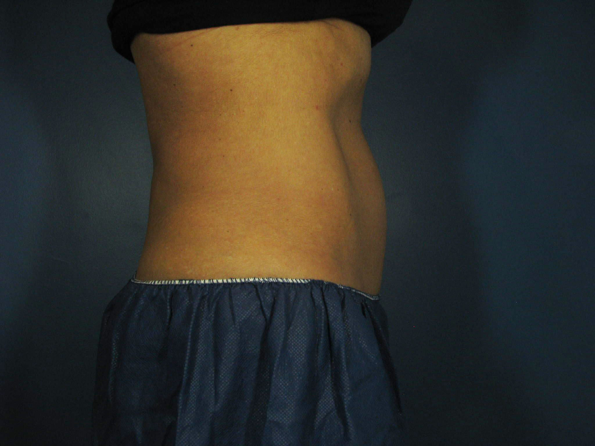 After Image: CoolSculpting - right-side