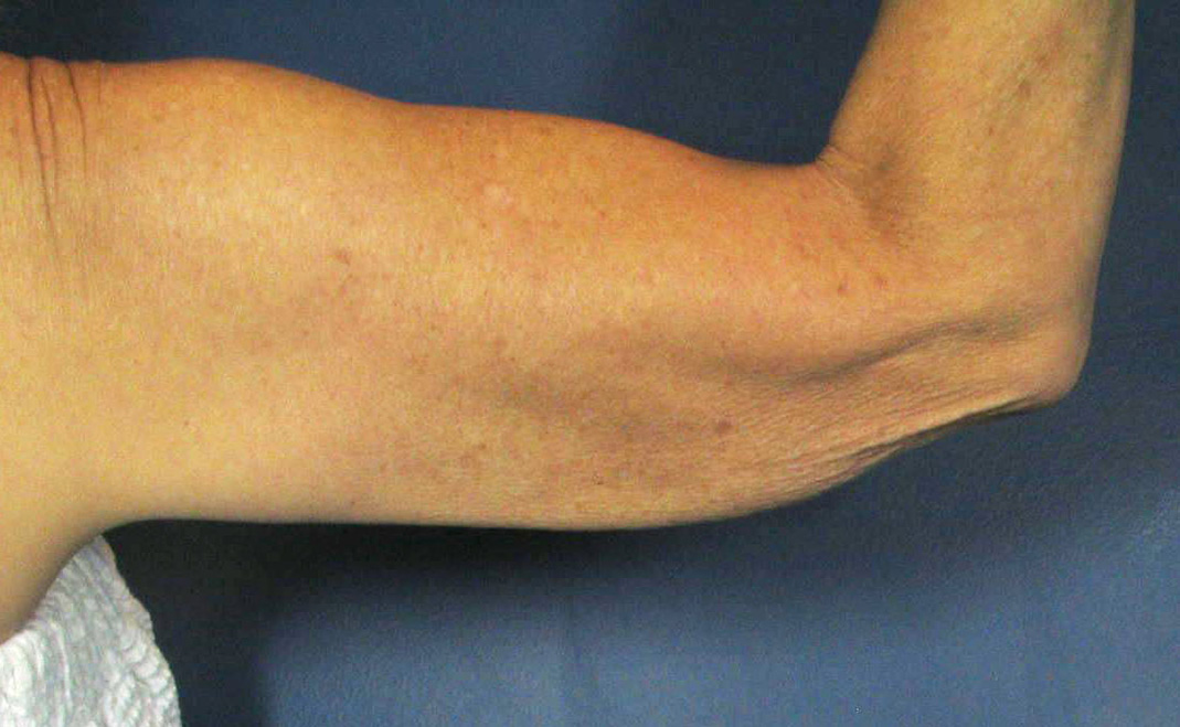 After Image: CoolSculpting - back