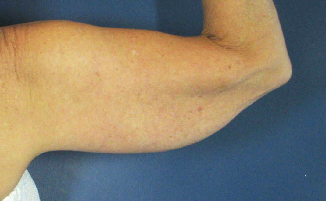 Before Image: CoolSculpting - back
