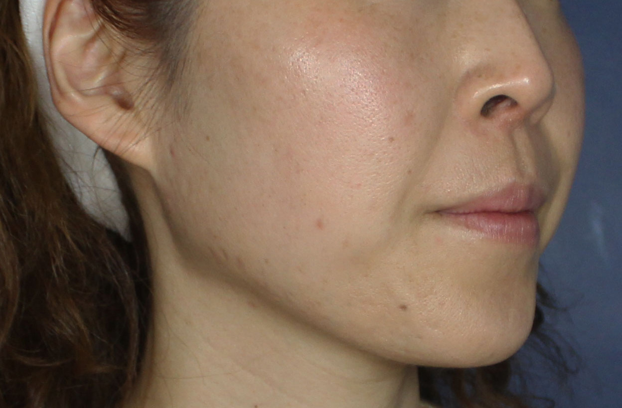 After Image: Chemical Peels - right-front-oblique