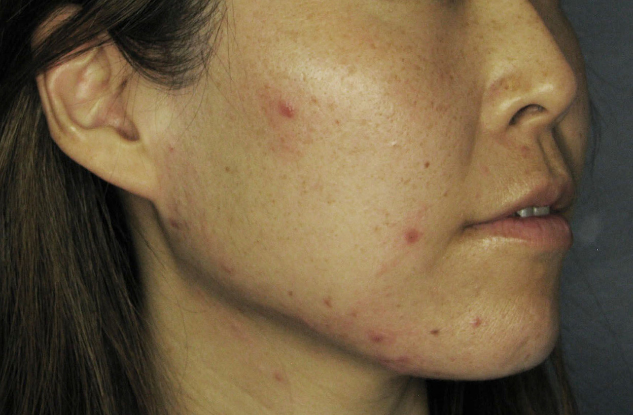 Before Image: Chemical Peels - right-front-oblique
