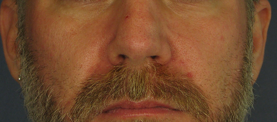 After Image: Chemical Peels - front