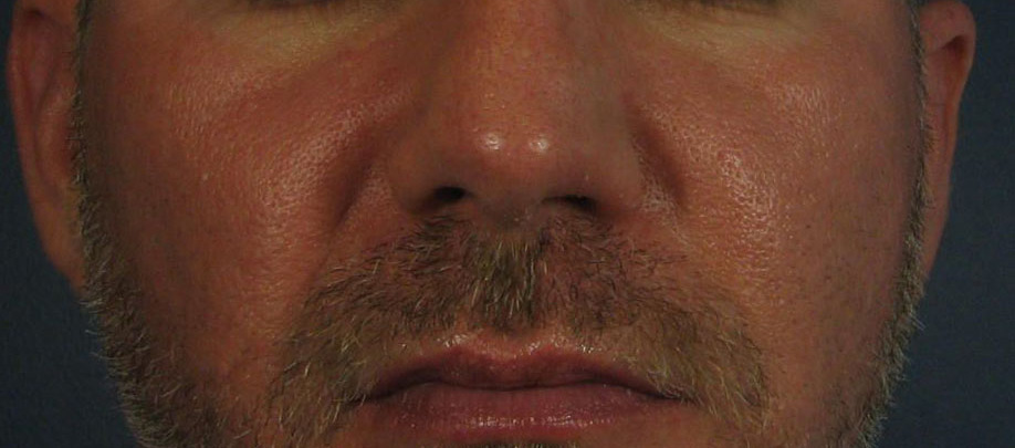 Before Image: Chemical Peels - front
