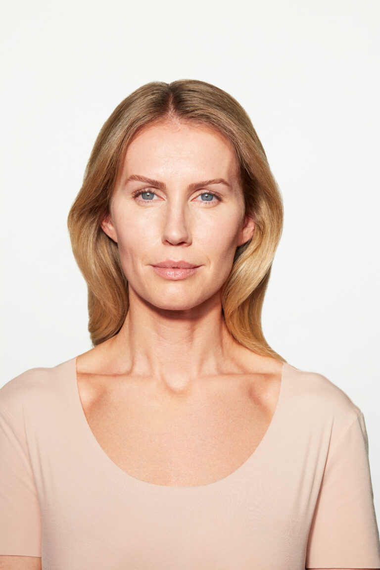 After Image: Sculptra - front