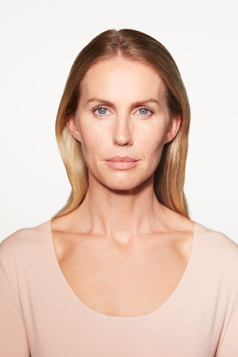 Before Image: Sculptra - front