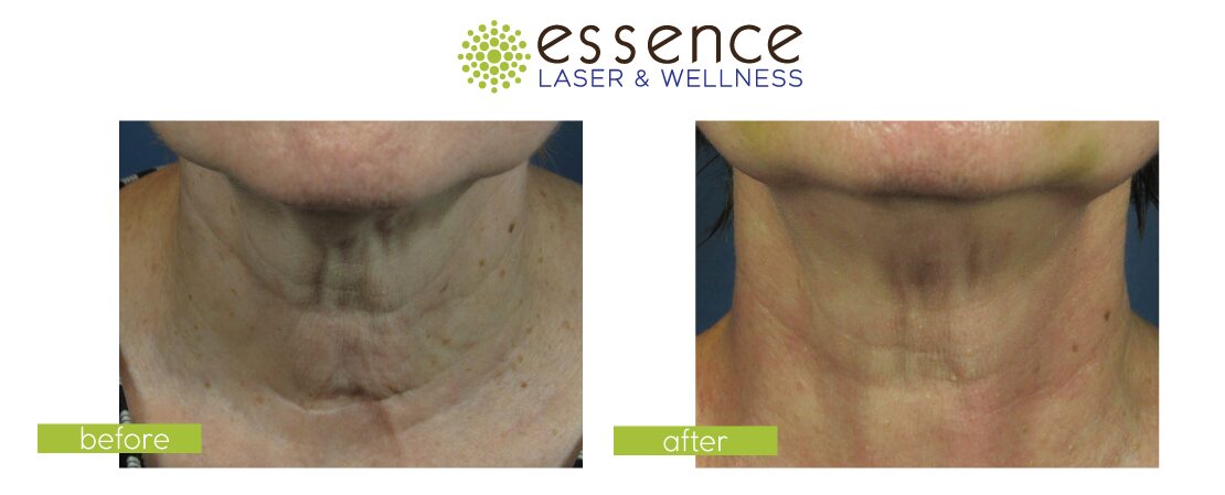 Before and After Image: Exilis Ultra 360 - front