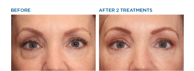 Before and After Image: Exilis Ultra 360 - front