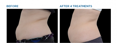 Before and After Image: Exilis Ultra 360 - left-side