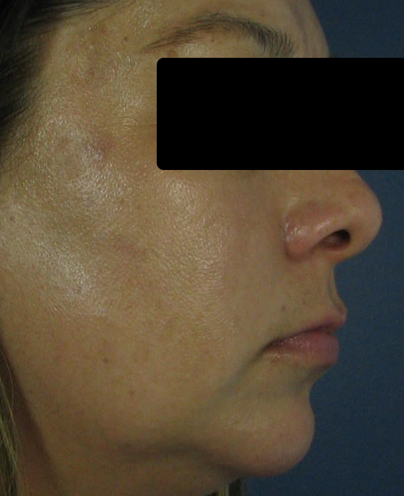 After Image: Intense Pulsed Light (IPL) - right-side