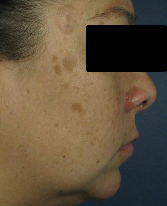 Before Image: Intense Pulsed Light (IPL) - right-side