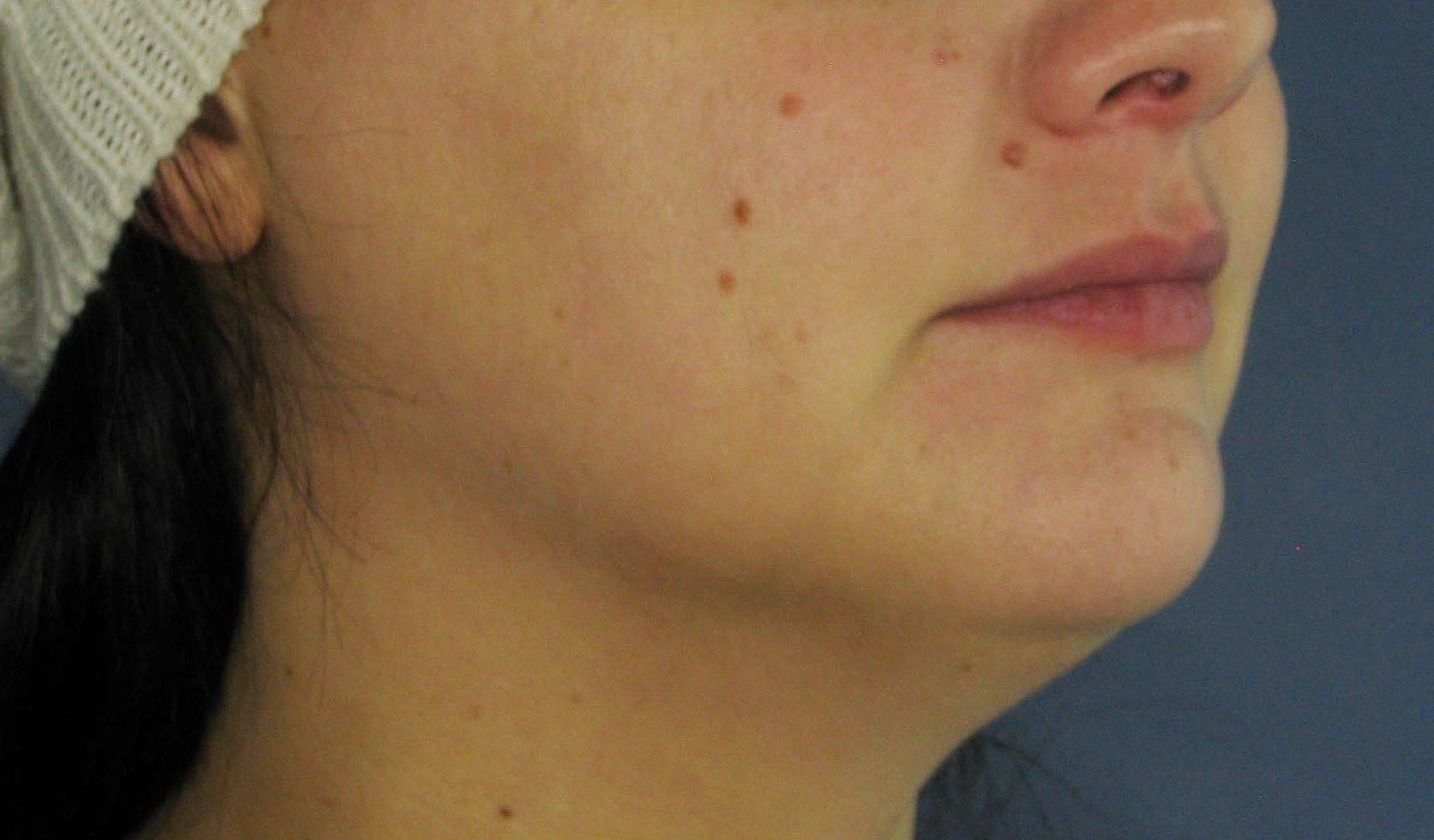 After Image: Kybella - right-front-oblique