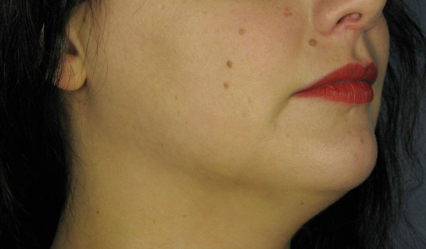 Before Image: Kybella - right-front-oblique