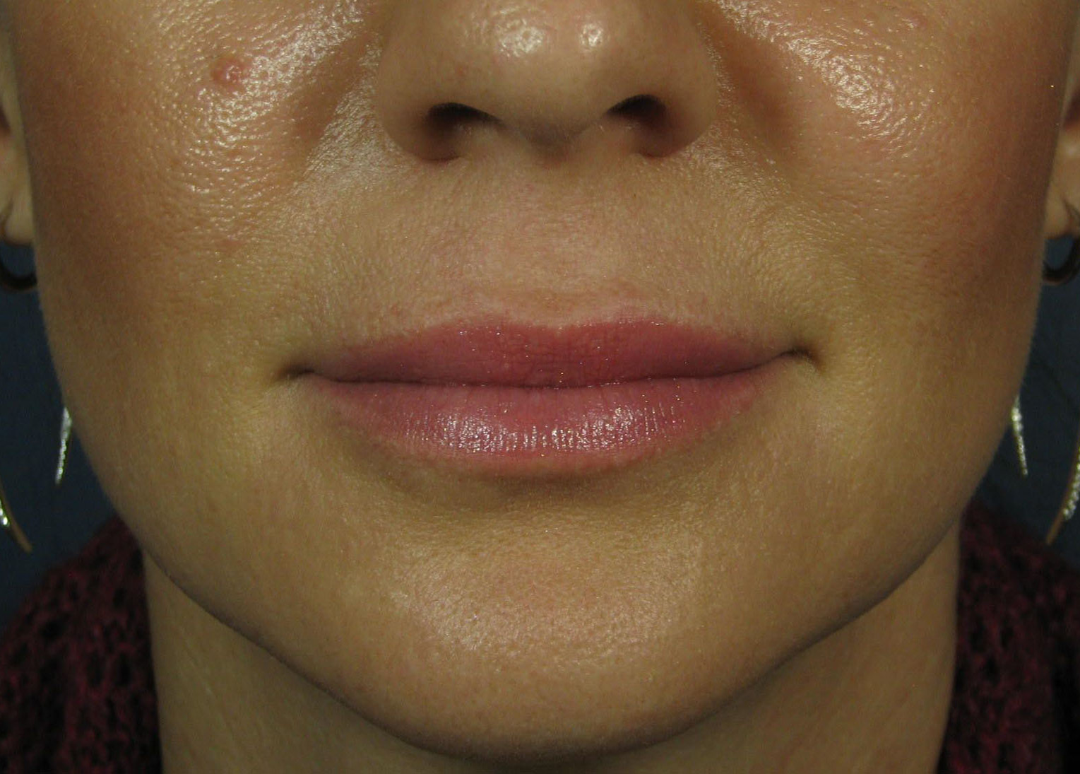 After Image: Juvederm XC - front