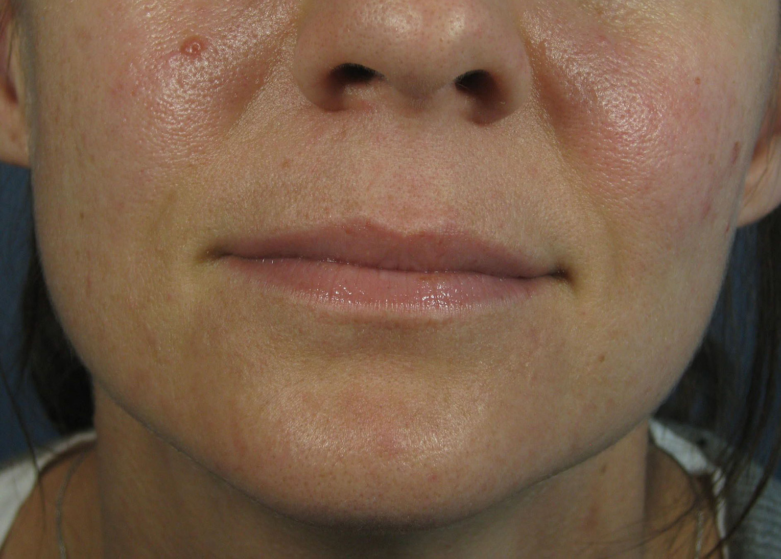 Before Image: Juvederm XC - front