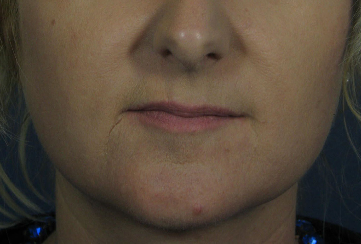 Before Image: Vollure - front
