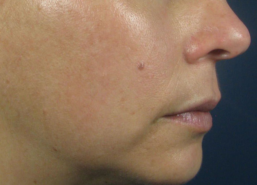 After Image: Intense Pulsed Light (IPL) - right-side