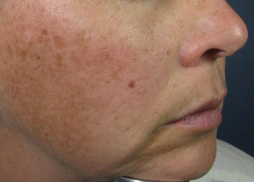 Before Image: Intense Pulsed Light (IPL) - right-side