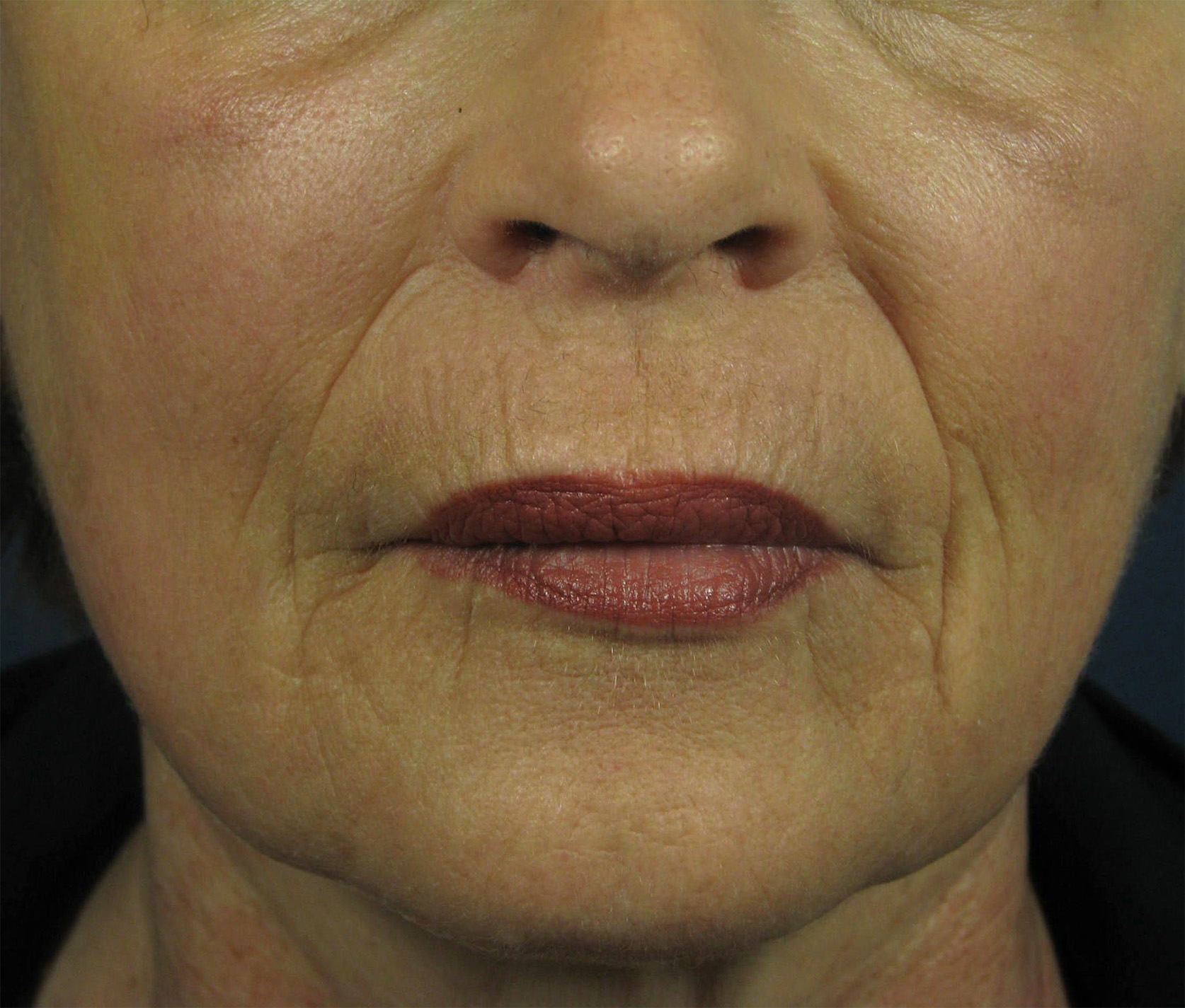 After Image: CO2 Fractional Laser Resurfacing - front