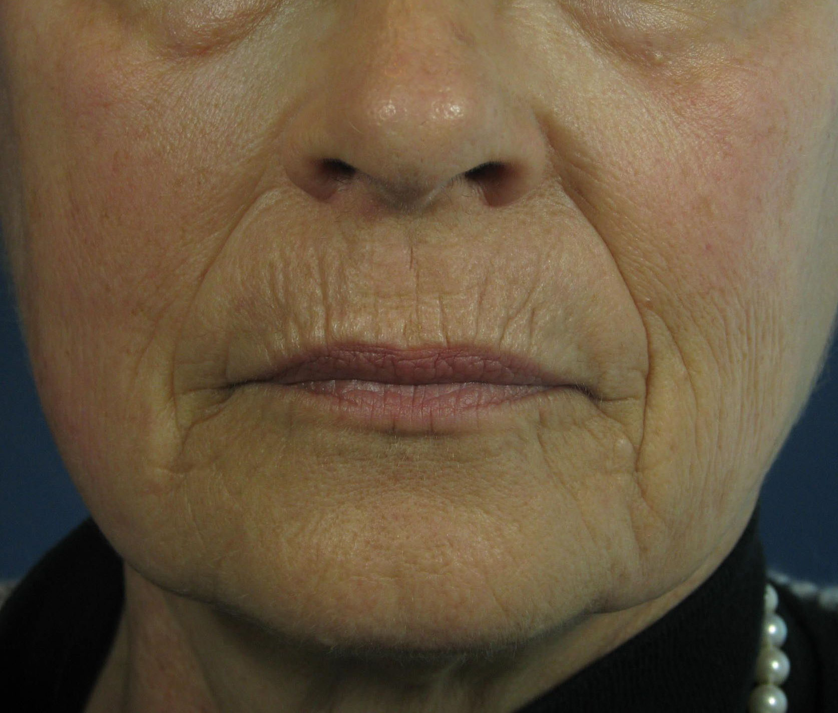 Before Image: CO2 Fractional Laser Resurfacing - front