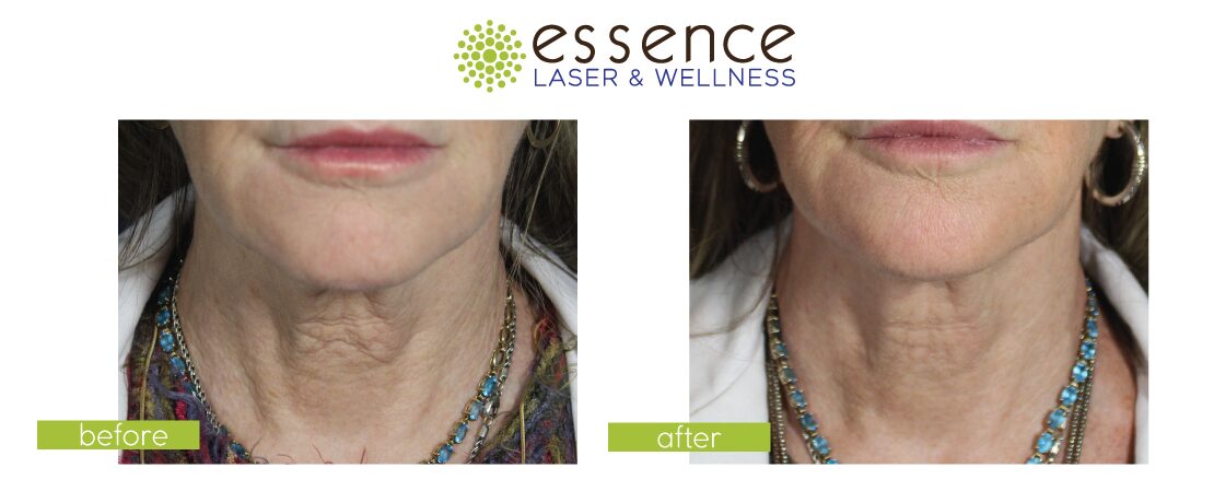 Before and After Image: Skinvive - front