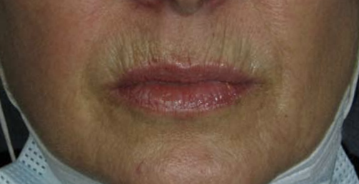 Before Image: Volbella - front