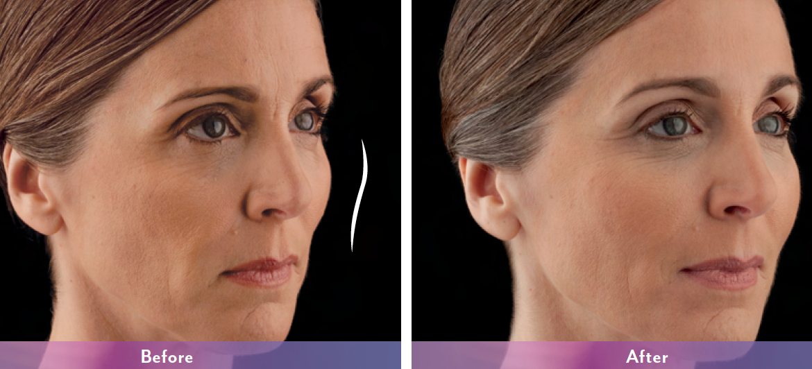Before and After Image: Vollure - right-front-oblique