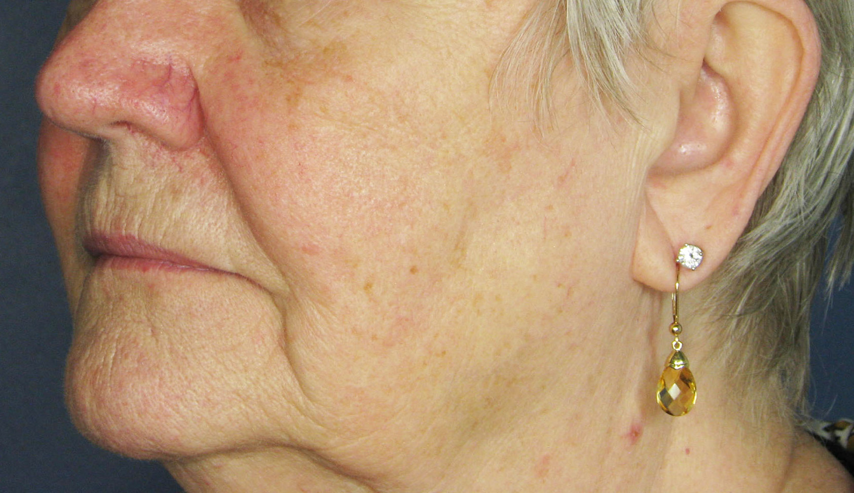 Before Image: Voluma XC - left-front-oblique