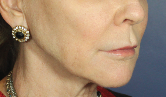 After Image: Volux - right-front-oblique