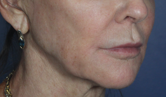 Before Image: Volux - right-front-oblique
