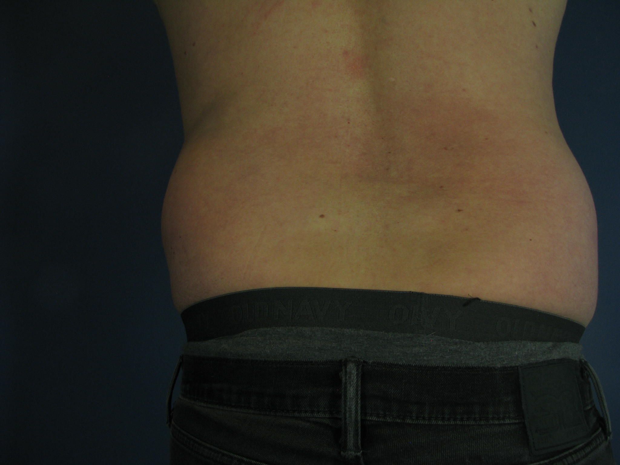 Before Image: CoolSculpting - back