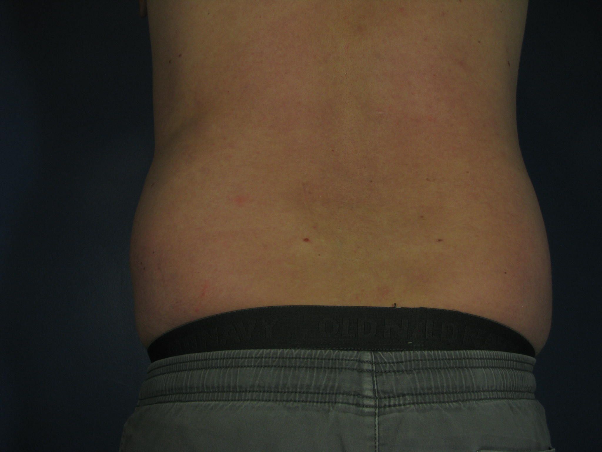 After Image: CoolSculpting - back
